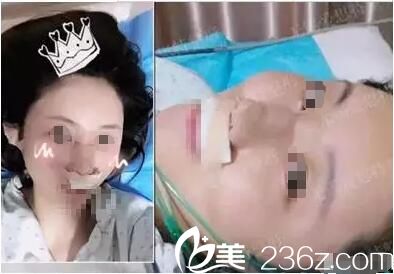 歐陽(yáng)黎平醫(yī)生隆鼻失敗修復(fù)術(shù)后即刻 歐陽(yáng)黎平醫(yī)生隆鼻失敗修復(fù)術(shù)后即刻