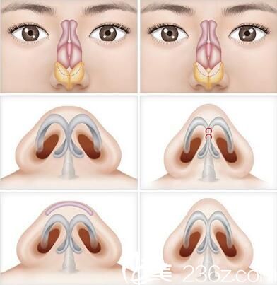 韓國Romian路美顏整形醫(yī)院鼻尖矯正 韓國Romian路美顏整形醫(yī)院鼻尖矯正