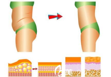 韓國Romian路美顏整形醫(yī)院吸脂圖 韓國Romian路美顏整形醫(yī)院吸脂圖