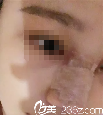 韓國ITEM（愛婷）整形醫(yī)院案例