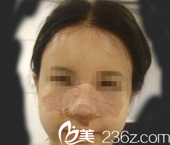 韓國ITEM（愛婷）整形醫(yī)院案例