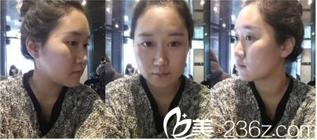   韓國Romian路美顏整形做下頜角效果怎么樣？下頜角切除真人案例