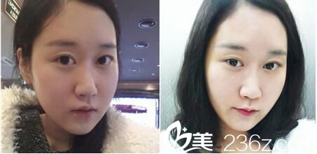 韓國Romian路美顏整形醫(yī)院真人案例圖5 韓國Romian路美顏整形醫(yī)院真人案例圖5