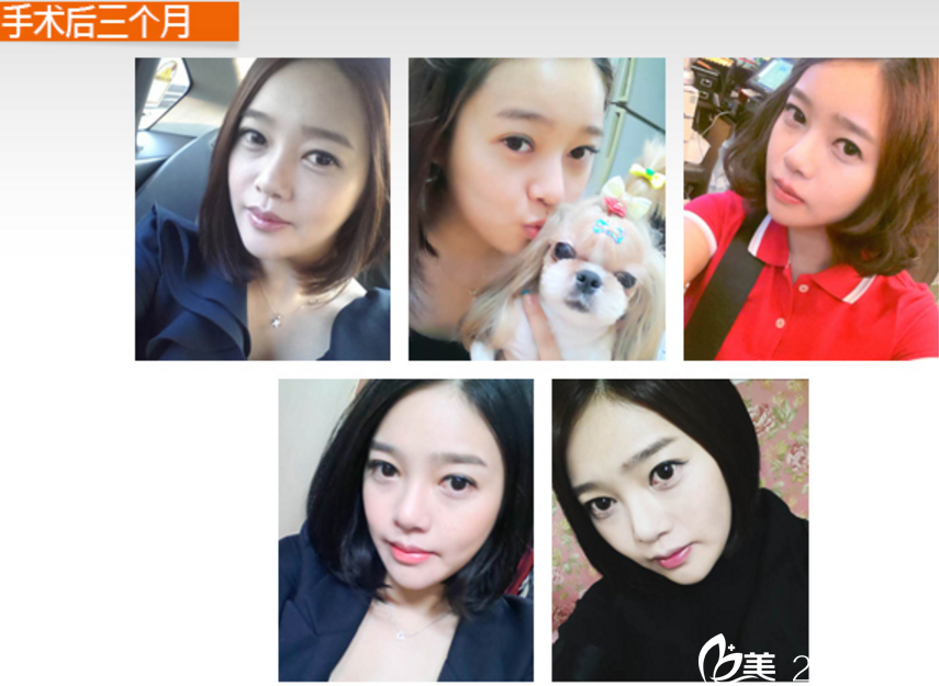 憂郁少女在韓國博朗溫做面部輪廓+脂肪移植成為校園宣傳模特