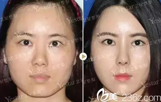 杭州藝星王光建醫(yī)生鼻綜合<span style= 杭州藝星王光建醫(yī)生鼻綜合<span style=