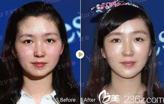 杭州藝星王光建自體脂肪面部填充<span style= 杭州藝星王光建自體脂肪面部填充<span style=