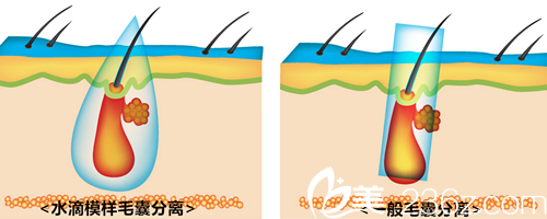 JJ洪鎮(zhèn)柱整形外科毛發(fā)移植怎么樣？多少錢？