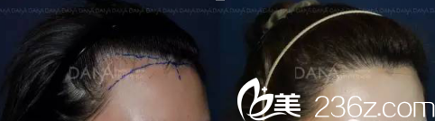 JJ洪鎮(zhèn)柱整形外科毛發(fā)移植案例