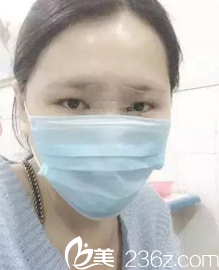 韓國(guó)opera整形醫(yī)院金錫漢院長(zhǎng)做假體墊下巴3