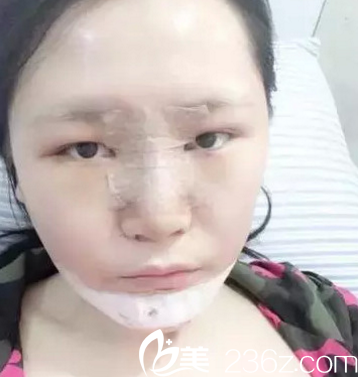 韓國(guó)opera整形醫(yī)院金錫漢院長(zhǎng)做假體墊下巴2