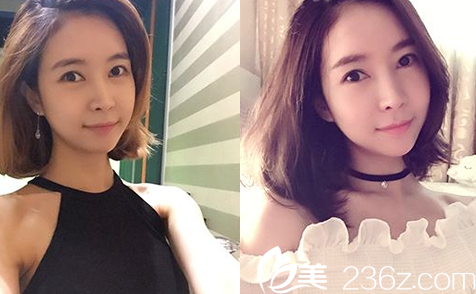 韓國(guó)JJ洪鎮(zhèn)柱整形醫(yī)院洪鎮(zhèn)柱做輪廓手術(shù)真人<span style=