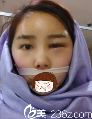 韓國(guó)JJ洪鎮(zhèn)柱整形醫(yī)院洪鎮(zhèn)柱做輪廓手術(shù)真人<span style=