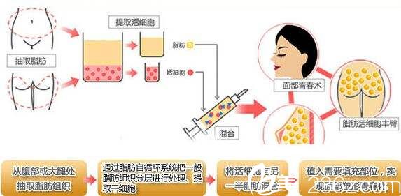 自體脂肪填充原理 自體脂肪填充原理