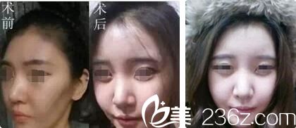 無(wú)錫同舟案例告訴你為什么脂肪要做二次填充效果才好