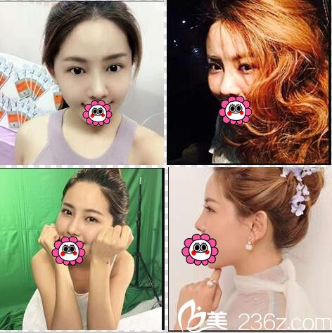 看我在歐菲整形找袁純新醫(yī)生做膨體隆鼻的恢復(fù)效果好不好