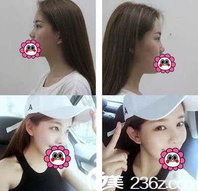 歐菲隆鼻23天效果對比 歐菲隆鼻23天效果對比