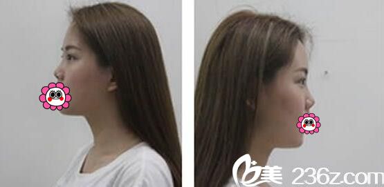 <!--<i data=20240703-sp></i>-->歐菲整形隆鼻前 <!--<i data=20240703-sp></i>-->歐菲整形隆鼻前