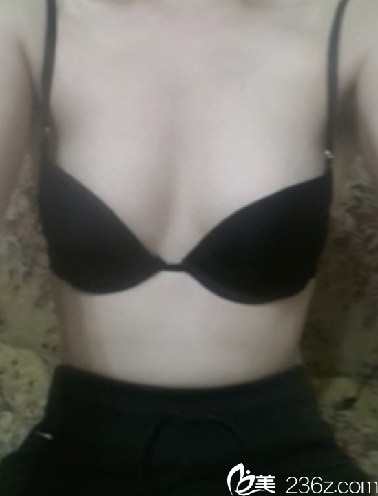 韓國(guó)赫爾希隆胸真人案例 