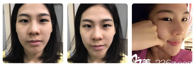 雙眼皮術前照片 雙眼皮術前照片