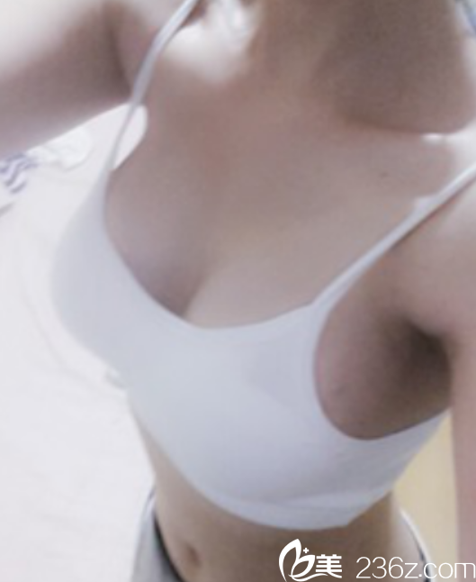 金應(yīng)森院長(zhǎng)做假體隆胸真人案例