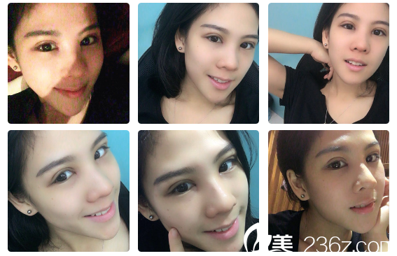 廣州軍美產(chǎn)慎之做完雙眼皮8天自拍 廣州軍美產(chǎn)慎之做完雙眼皮8天自拍