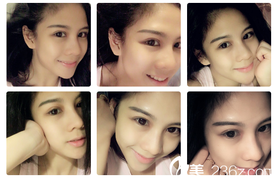 找廣州軍美產(chǎn)慎之割完雙眼皮1個月了 找廣州軍美產(chǎn)慎之割完雙眼皮1個月了