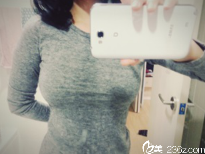 韓國赫爾希金應(yīng)森院長做水滴型假體隆胸真人案例