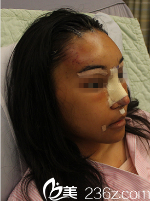 韓國(guó)DREAM夢(mèng)想整形外科醫(yī)院案例