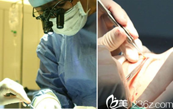 顯微鏡下操作雙眼皮手術(shù) 顯微鏡下操作雙眼皮手術(shù)