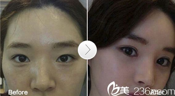 微創(chuàng)三點雙眼皮真人 微創(chuàng)三點雙眼皮真人