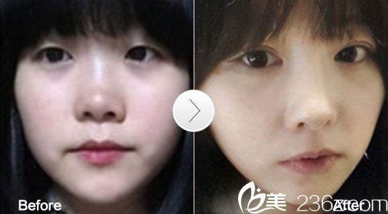 埋線法雙眼皮真人 埋線法雙眼皮真人