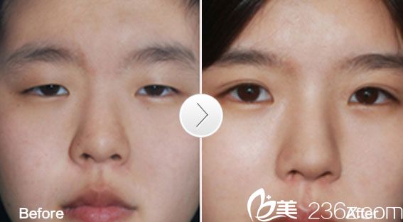 尚麗全切雙眼皮 尚麗全切雙眼皮