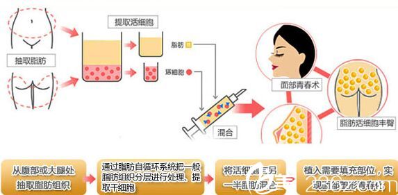 自體脂肪填充原理