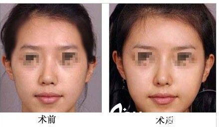 顳部（太陽穴）脂肪填充前后對比