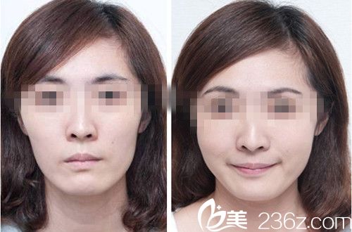 蘋果肌脂肪填充對比圖