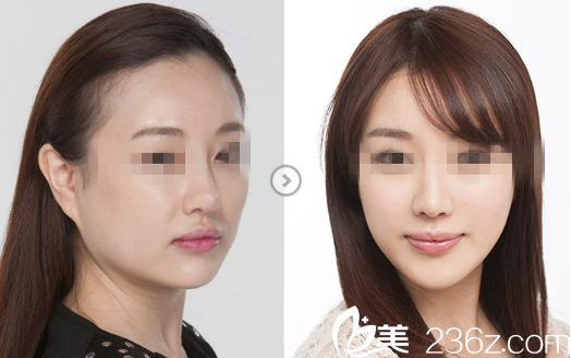 側(cè)面部脂肪填充前后對比