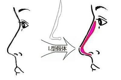 L型假體植入隆鼻