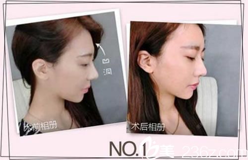 臺州藝星劉興達(dá)注射玻尿酸案例 臺州藝星劉興達(dá)注射玻尿酸案例