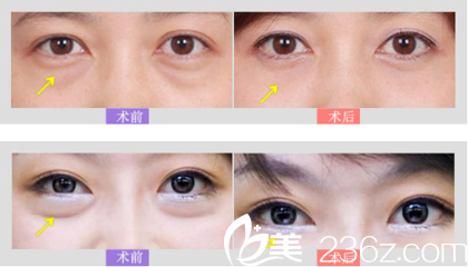外路法祛眼袋的優(yōu)點(diǎn)大于內(nèi)路法，但是風(fēng)險(xiǎn)也大