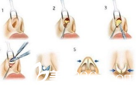 韓國(guó)iFace整形外科醫(yī)院鼻部整形示意圖