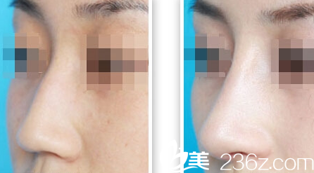 韓國(guó)iFace整形外科醫(yī)院案例