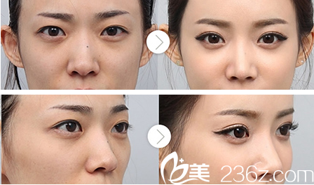 合肥福華整形醫(yī)院趙章杰雙眼皮案例 合肥福華整形醫(yī)院趙章杰雙眼皮案例