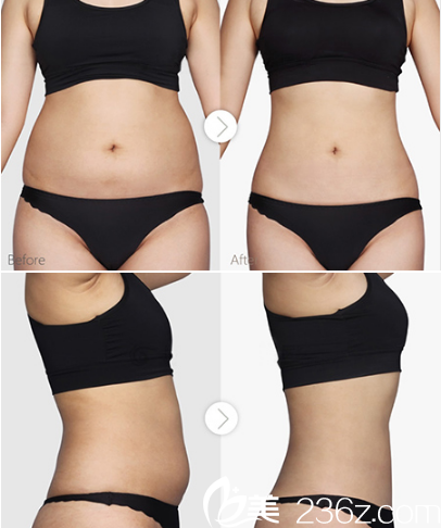 合肥福華李建云腹部吸脂案例對比圖 合肥福華李建云腹部吸脂案例對比圖