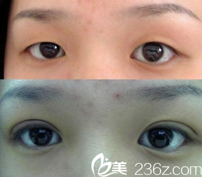 <!--<i data=20240703-sp></i>-->伊萊美整形醫(yī)院效果好不好？看邱文苑醫(yī)生的術后圖就知道。