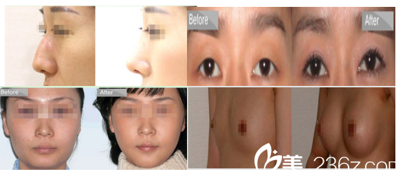 韓國olive整形外科醫(yī)院案例 韓國olive整形外科醫(yī)院案例