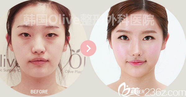 olive整形鼻部案例 olive整形鼻部案例