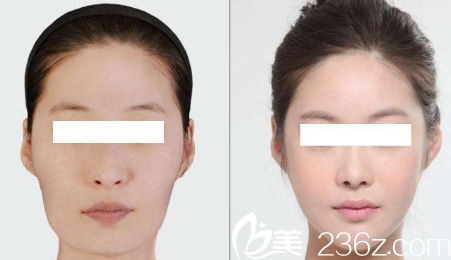 olive整形面部輪廓案例 olive整形面部輪廓案例