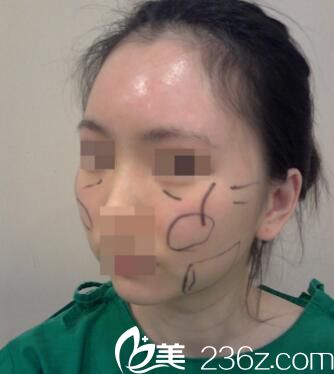 韓國Small Face整形外科真人案例1 韓國Small Face整形外科真人案例1