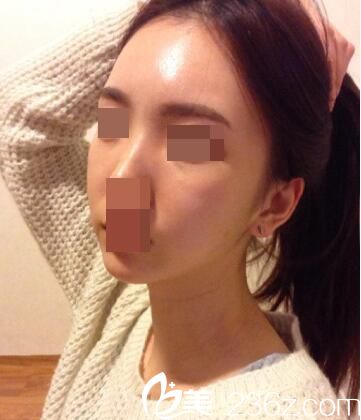   韓國(guó)Small Face整形外科張鎬做面部輪廓效果好不好？顴骨和面部吸脂真人手術(shù)案例