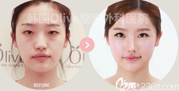 olive整形外科醫(yī)院案例 olive整形外科醫(yī)院案例